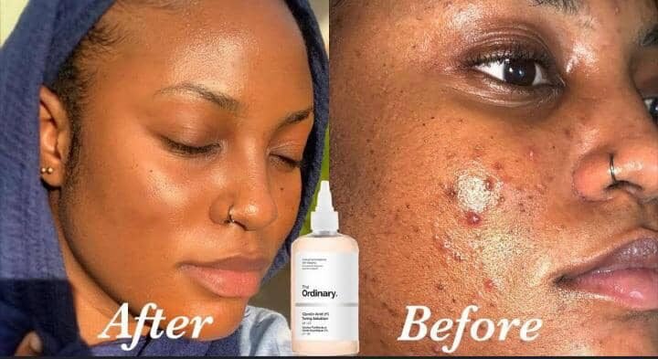 Excellent Peeling Skin Oil Lightening Exfoliating Extra Strength for Face Body